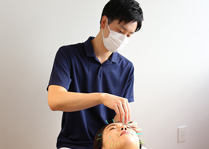 美容鍼で理想の小顔に
