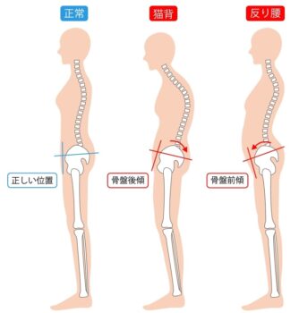 くびれができない人に共通する原因:反り腰・猫背などの姿勢の崩れ