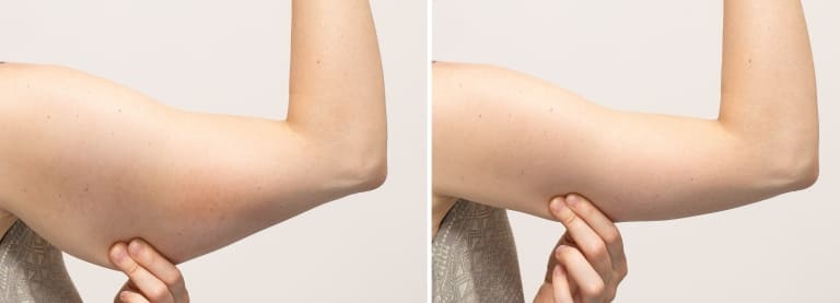 二の腕の太さの変化イメージ